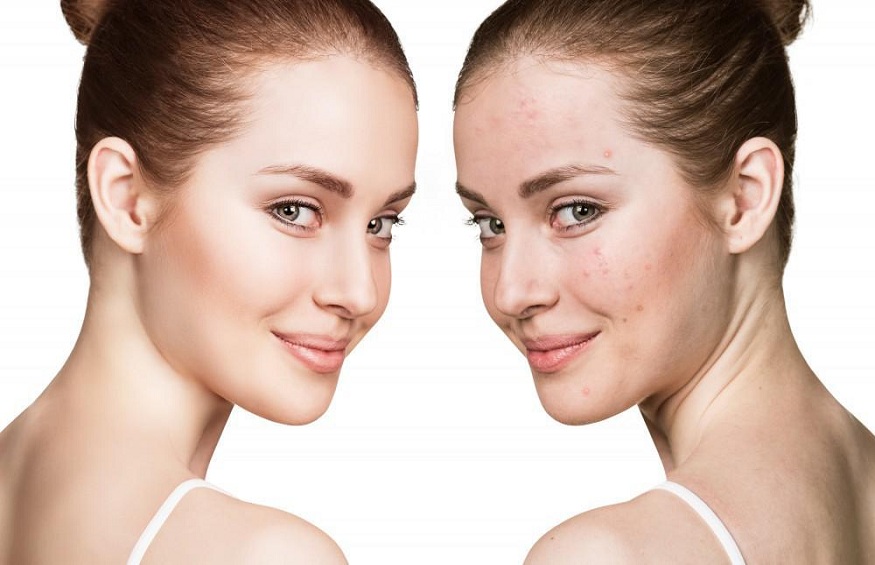 Which adults are affected by acne?