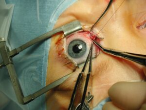 laser eye surgery
