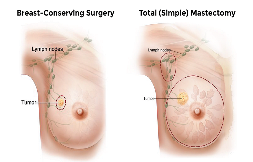 Male Breast Cancer: All You Need To Know