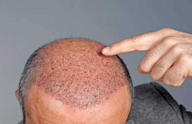 The Journey of Hair Regrowth: A Year After Your Hair Transplant in Turkey