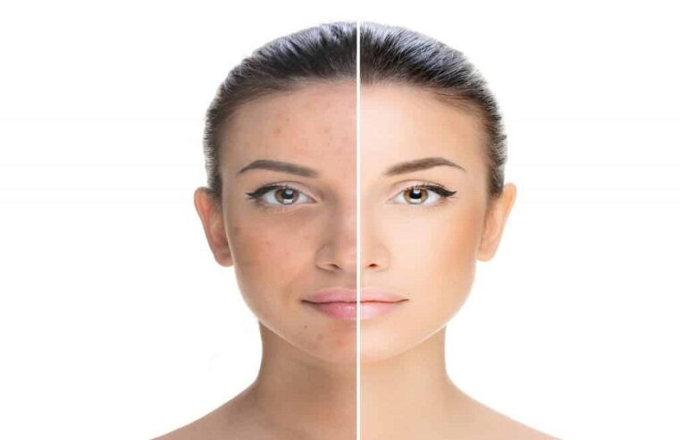 Pigmentation Treatment