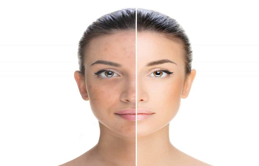 How to Use Thiamidol for Maximum Results in Pigmentation Treatment?