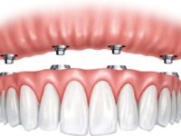 Dental Implants