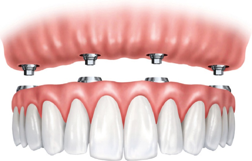 Dental Implants for Seniors: Is It Ever Too Late to Get Them