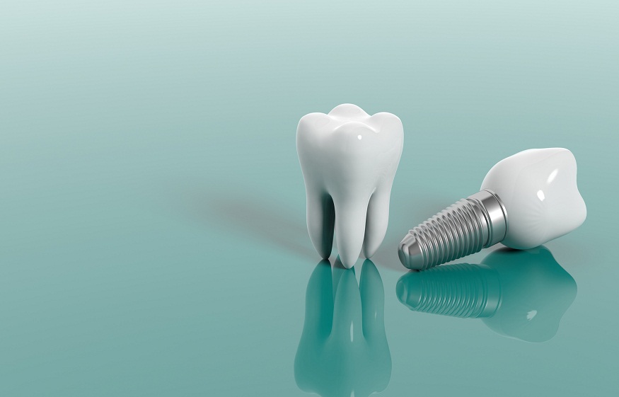 Why Are Dental Implants Expensive?