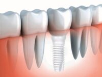 Titanium vs. Zirconia