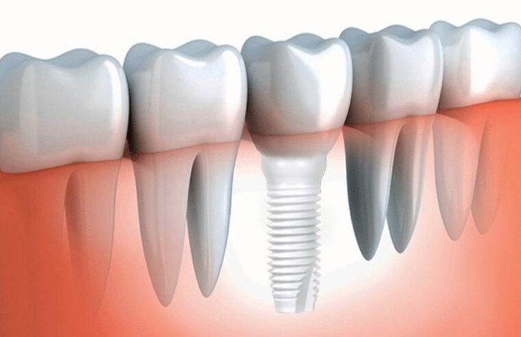 Titanium vs. Zirconia