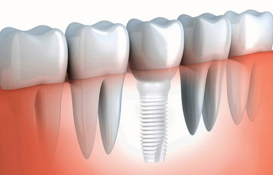 Does the Type of Implant Material Affect the Cost? Titanium vs. Zirconia