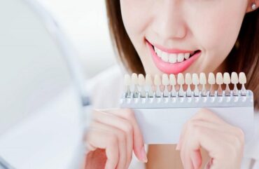 Can You Whiten Dental Implants? What You Need to Know