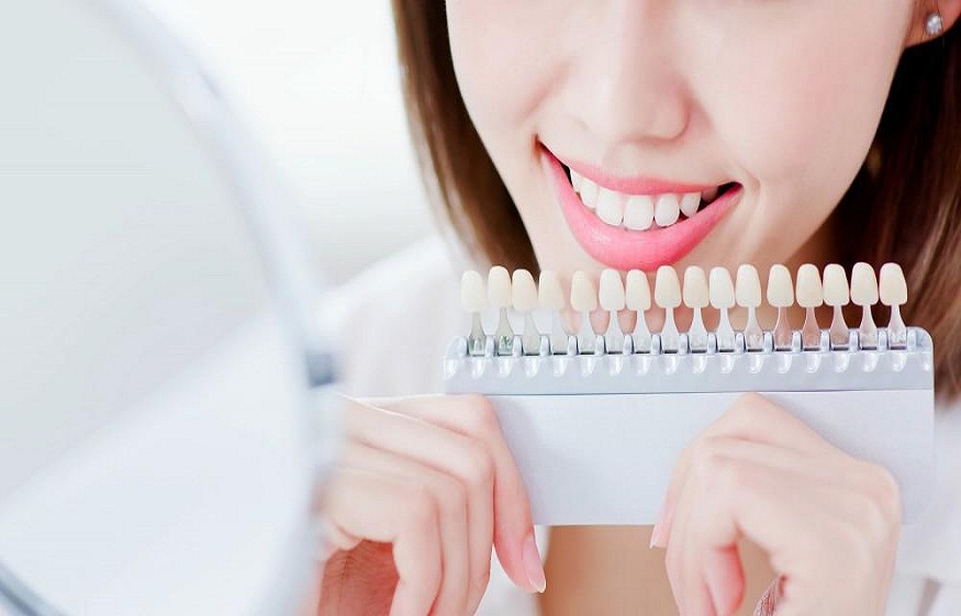 Can You Whiten Dental Implants? What You Need to Know