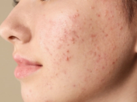 how to remove pimple marks