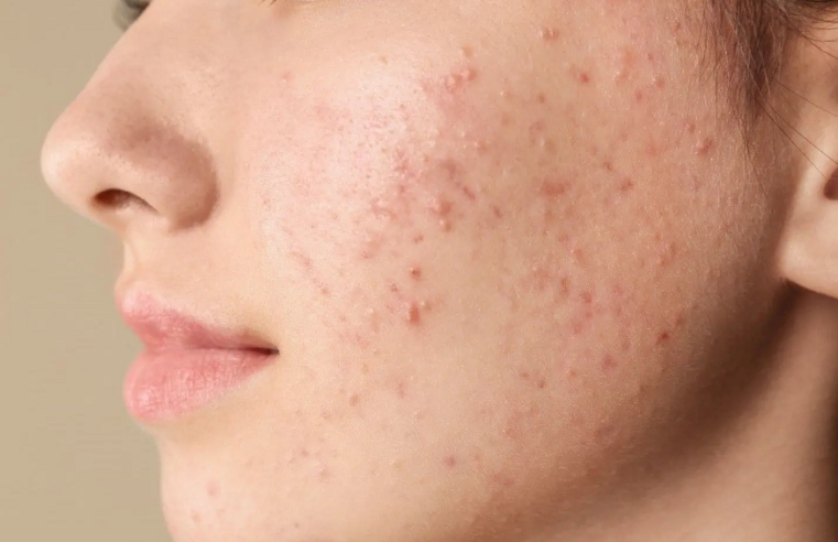 How to Fade Pimple Marks with Salicylic Acid