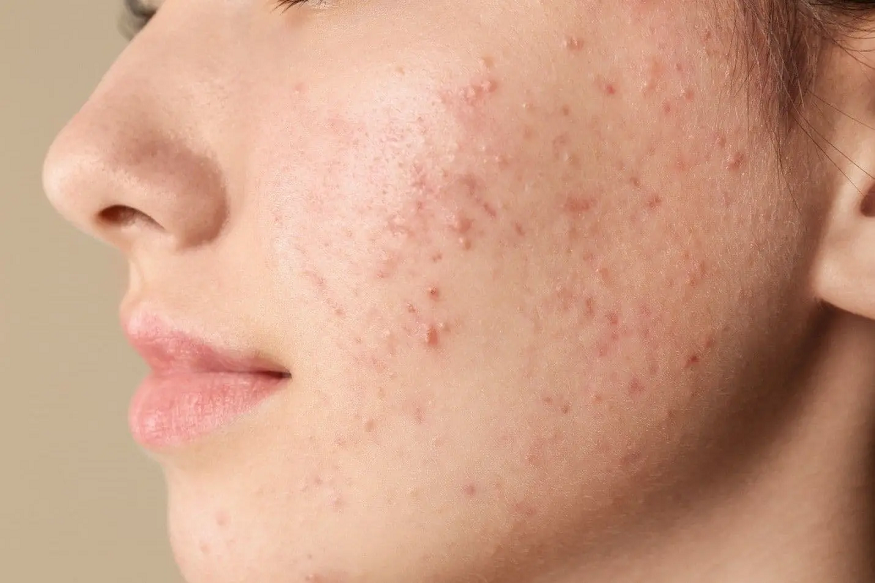 How to Fade Pimple Marks with Salicylic Acid