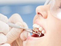 Wisdom teeth removal in Sydney