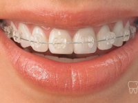 invisible braces cost Sydney