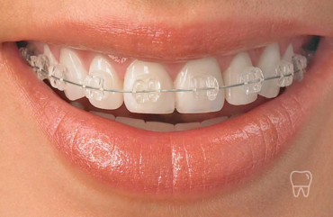 What Can and Can’t Be Treated with Clear Aligners